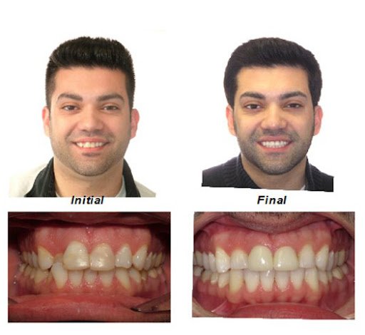 Invisalign before after