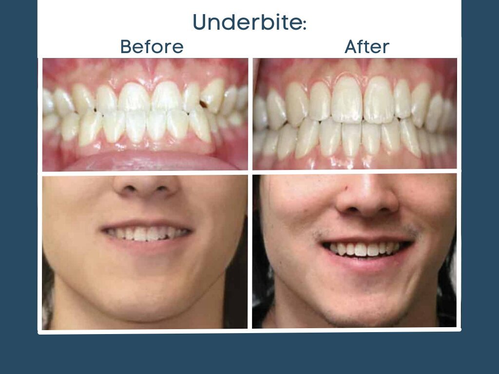 Underbite before and after
