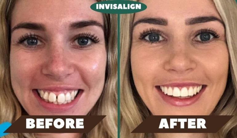 before and after Invisalign