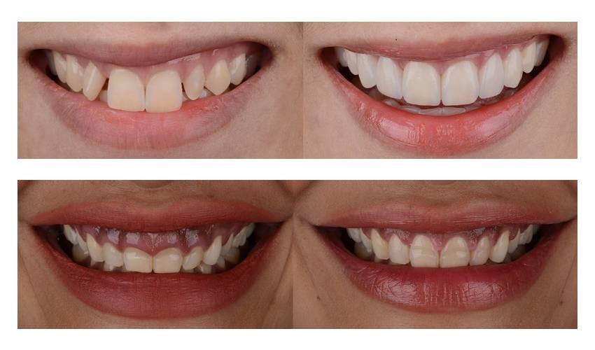 clear aligners before after