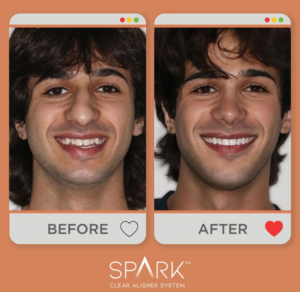spark aligners before and after