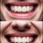smilepath treated alignment