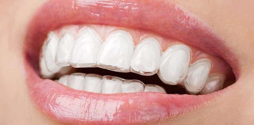 aligners before and after