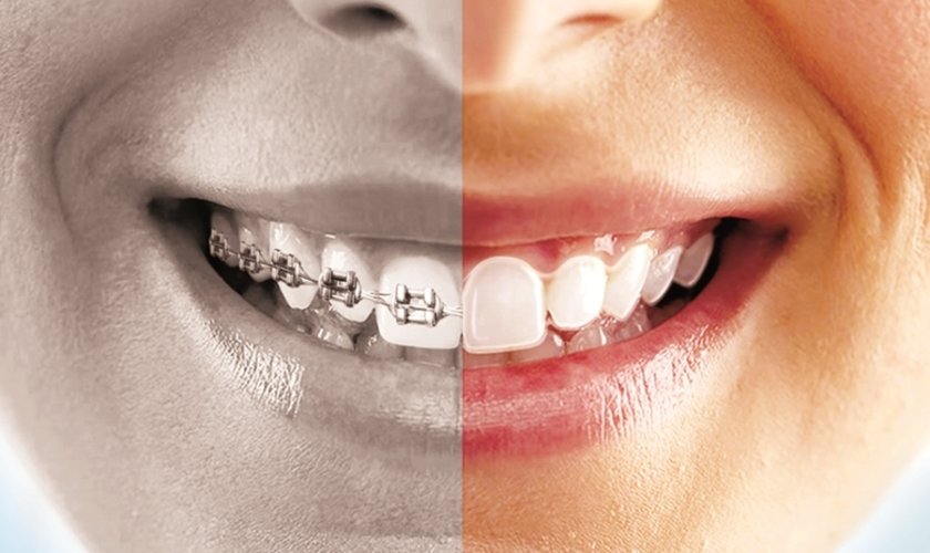 clear aligners vs braces